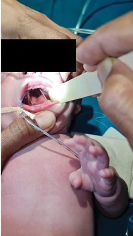 Cleft Palate-Lateral Synechiae Syndrome: A Case Report.