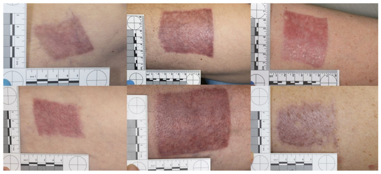 Suprathel Versus Hypafix in the Management of Split-Thickness Donor Site Wounds in the Elderly: A Randomised Controlled Trial.
