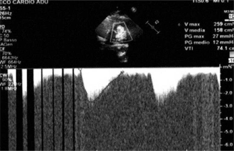 Generalized arterial calcifications in a twin recipient treated with etidronate: description of a case report within a narrative review.