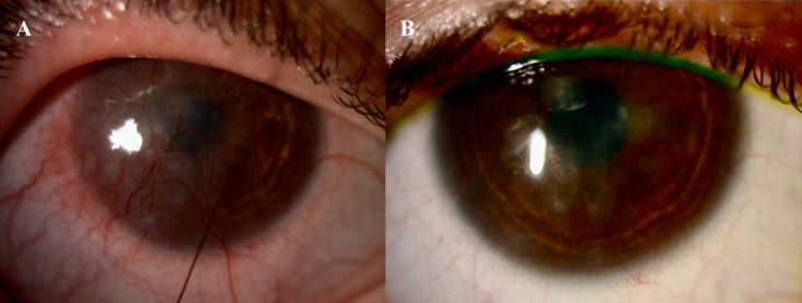 Evaluation of Medically Reversible Limbal Stem Cell Deficiency.