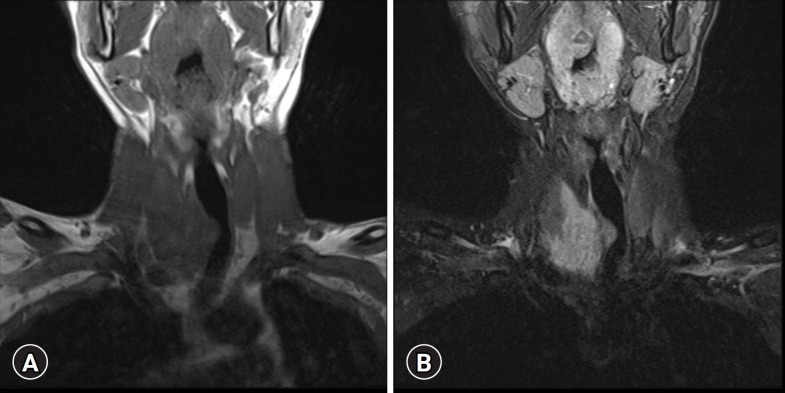 A 32-year-old man with plexiform schwannoma of the thyroid gland: a case report.