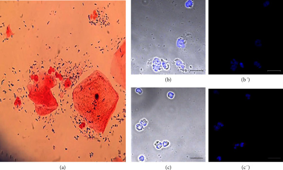 Extracellular Traps in Patients Diagnosed With Bacterial Vaginosis, Trichomoniasis, Candidiasis, Noninfectious Vaginitis and Cytolytic Vaginosis.
