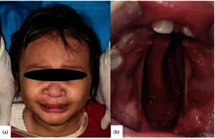 Honey as an Alternative Dressing in Post-Palatoplasty-Two Case Reports.