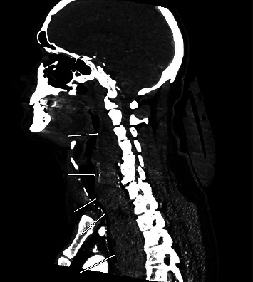 Clinical Challenges and Surgical Interventions in Managing Neck Hematoma After Cervical Spine Fusion: A Case Report.