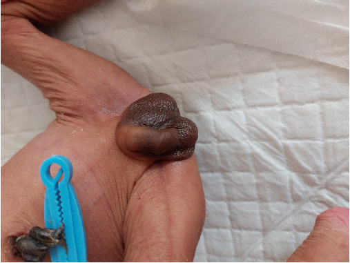 A Neonate Presenting with Severe Dehydration: A Rare Case of Congenital Adrenal Hyperplasia with Salt Losing Crisis.