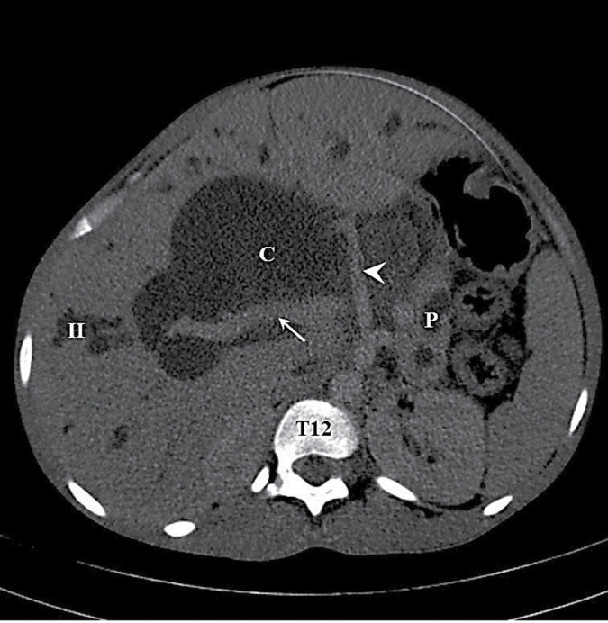 Huge Choledochal Cyst in a 26-Year-Old Female: A Case Report.