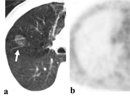 Impacts of <sup>18</sup>F-FDG PET/CT Parameters on Differential Diagnosis and Outcome of Patients with Primary Invasive Mucinous and Lepidic Predominant Adenocarcinoma of the Lung.