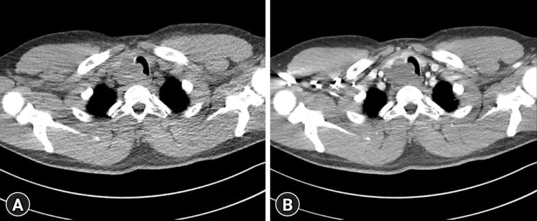 A 32-year-old man with plexiform schwannoma of the thyroid gland: a case report.