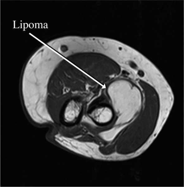 Posterior interosseous nerve lesion due to lipoma. Review of the literature and rare case presentation.
