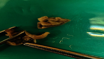 <i>Enterobius vermicularis</i> in the Appendiceal Lumen: A Case Report.