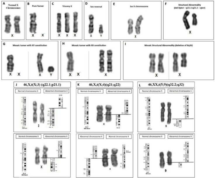 Cytogenetic Evaluation and Clinical Correlation: A Retrospective Analysis of East Indian Patients with Diverse Amenorrhea Profiles.