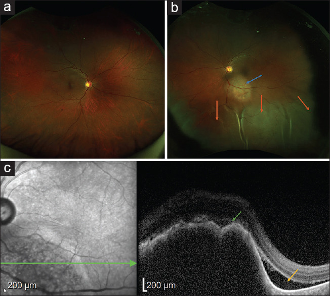 Choroidal metastasis as the initial manifestation of lung carcinoma.