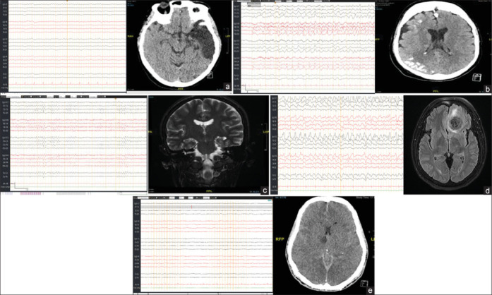 Clinical and Radiological Parameters Affecting the Yield of Routine Electroencephalography in Various Indications.