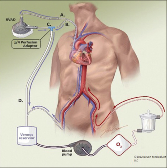Maintaining a Bloodless Field for HeartMate 3 Placement: Splicing an RVAD Outflow Cannula into the CPB Venous Reservoir for Complete LV Emptying.