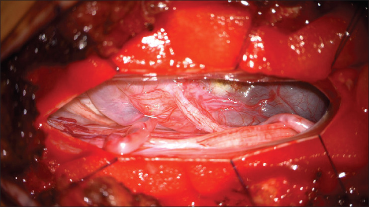 Mobile schwannomas of the spine: Diagnostic and surgical considerations of two cases.