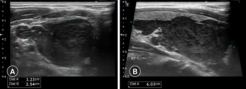 A 32-year-old man with plexiform schwannoma of the thyroid gland: a case report.