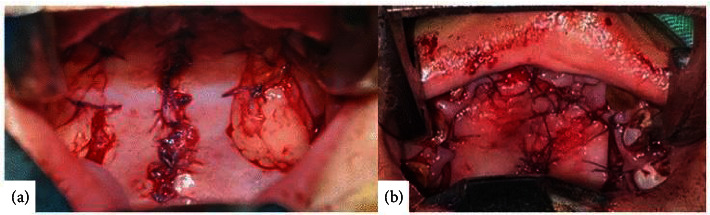 Honey as an Alternative Dressing in Post-Palatoplasty-Two Case Reports.