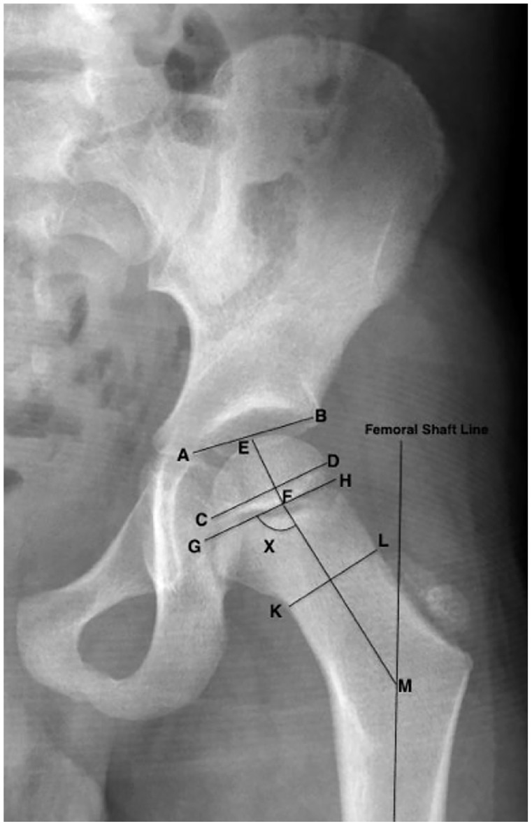 The impact of neurological impairment and tone on hip joint development.