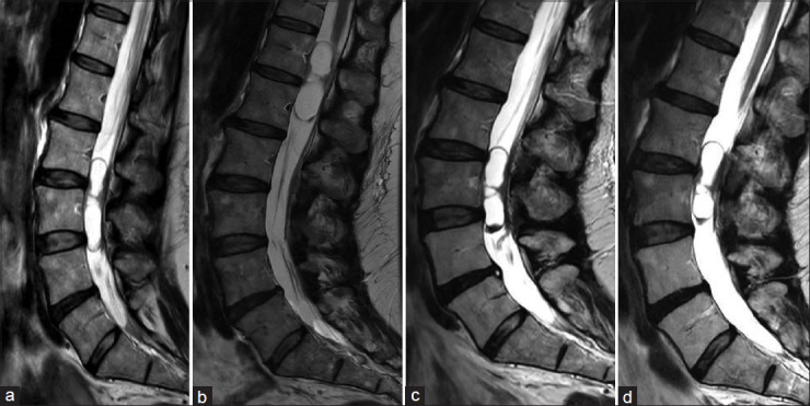 Mobile schwannomas of the spine: Diagnostic and surgical considerations of two cases.