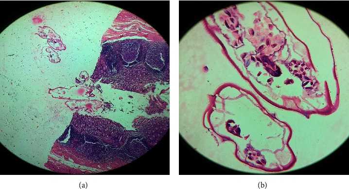 <i>Enterobius vermicularis</i> in the Appendiceal Lumen: A Case Report.