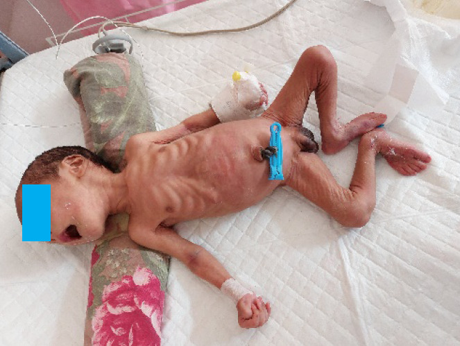 A Neonate Presenting with Severe Dehydration: A Rare Case of Congenital Adrenal Hyperplasia with Salt Losing Crisis.