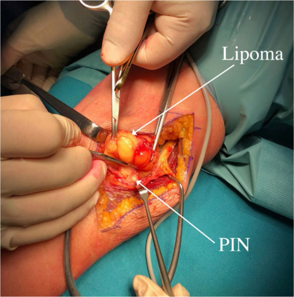 Posterior interosseous nerve lesion due to lipoma. Review of the literature and rare case presentation.