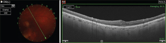 Foveal adhesion of a dexamethasone implant: Evaluation and follow-up via multimodal imaging.
