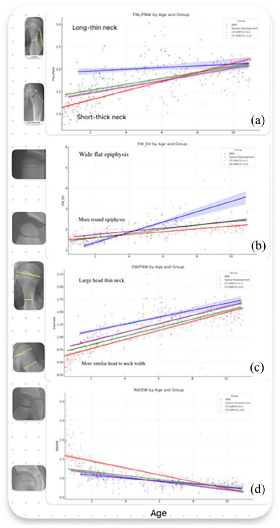 The impact of neurological impairment and tone on hip joint development.