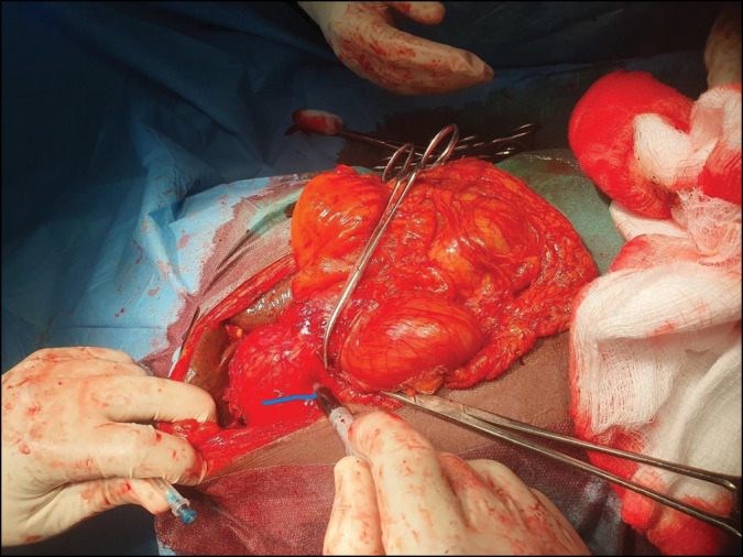 Huge Choledochal Cyst in a 26-Year-Old Female: A Case Report.
