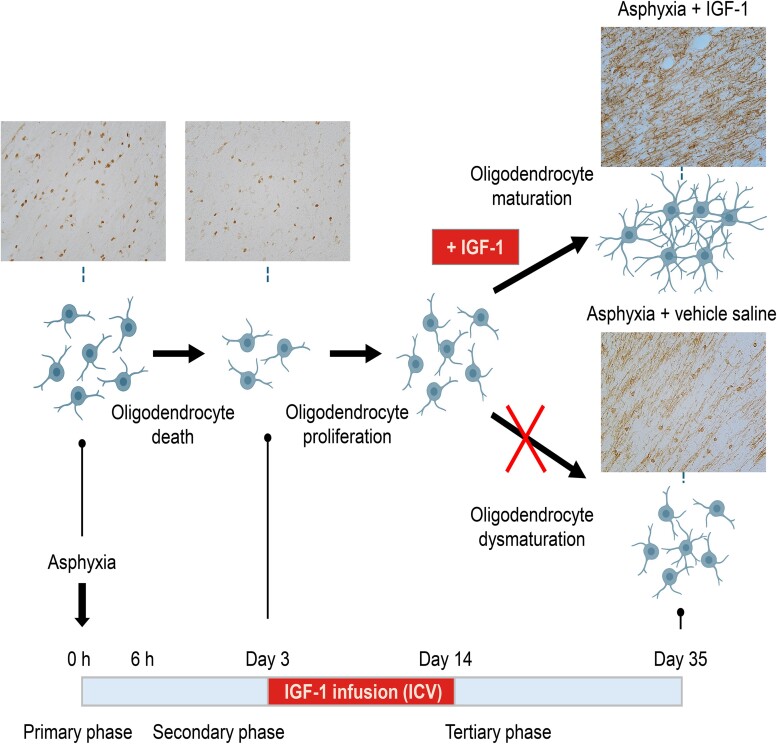 White matter protection with insulin-like growth factor-1 after hypoxia-ischaemia in preterm foetal sheep.