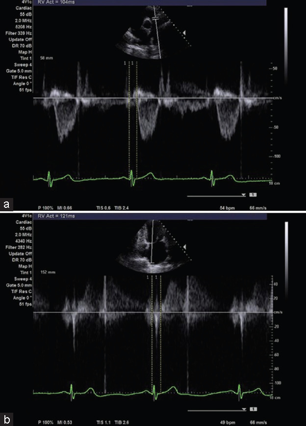 Pulmonary Arterial Hemodynamic Assessment by Pulmonary Pulse Transit Time before and after Balloon Mitral Valvuloplasty.
