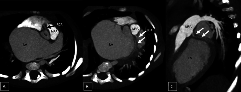 Giant Left Atrium in an Infant with Anomalous Origin of Left Coronary Artery from Pulmonary Artery.