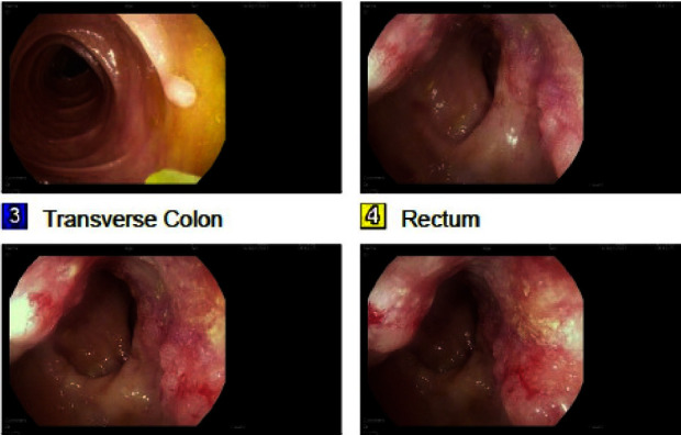 Rectal Adenocarcinoma With Pagetoid Spread: A Novel Entity.