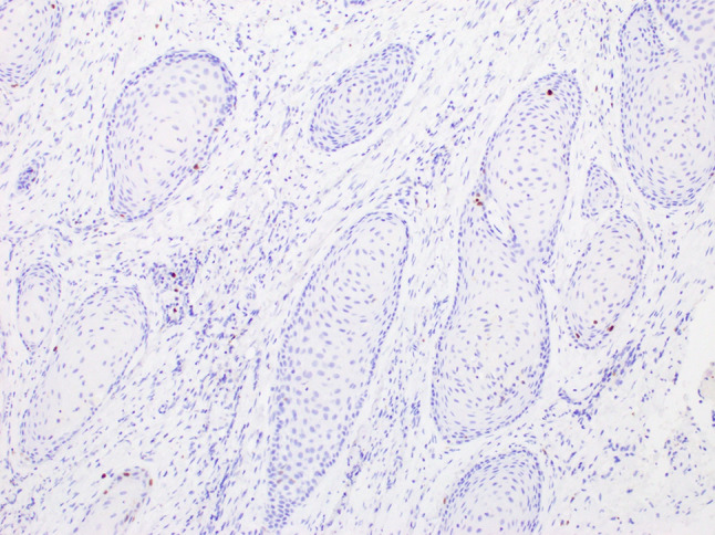 Squamous Cell Carcinoma Arising in a Squamous Odontogenic Tumor of the Maxilla: Case Report and Review of the Literature.