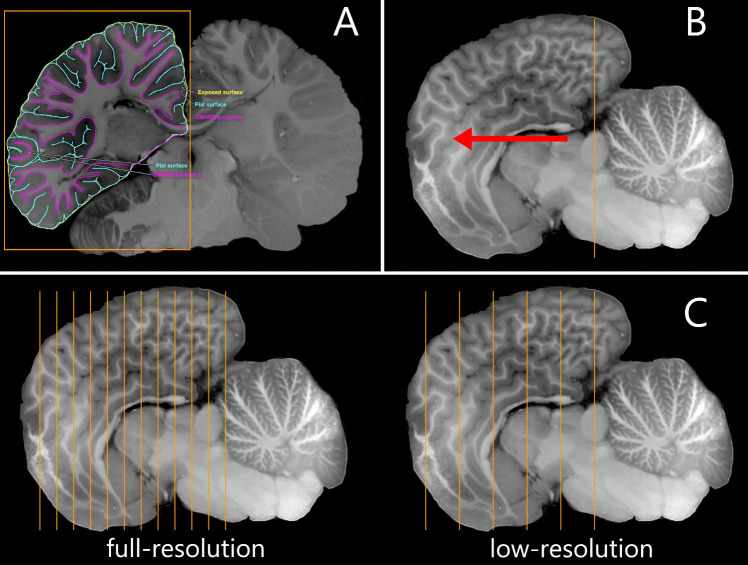 Stitcher: A Surface Reconstruction Tool for Highly Gyrified Brains.