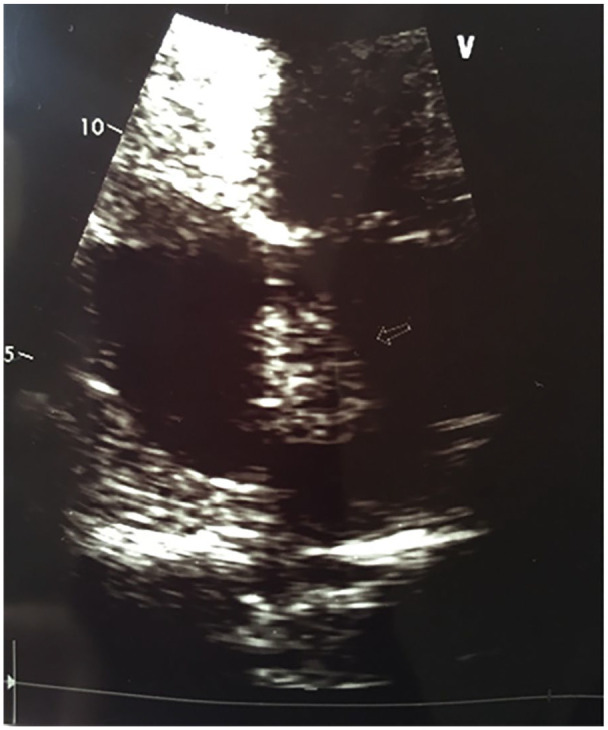 Male Infertility associated with a Novel <i>PRKAR1A</i> Mutation in Carney Complex.