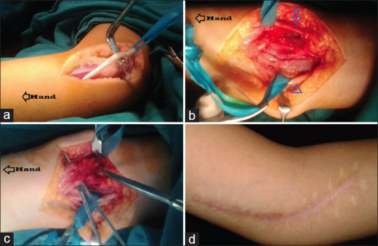 Staged Shoulder and Elbow Reconstruction in a Child with Obstetric Brachial Plexus Palsy: Six-year Follow-up.