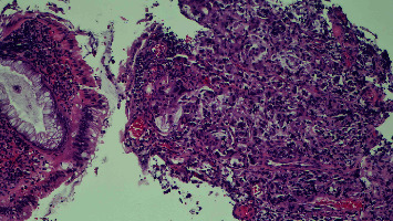 Rectal Adenocarcinoma With Pagetoid Spread: A Novel Entity.