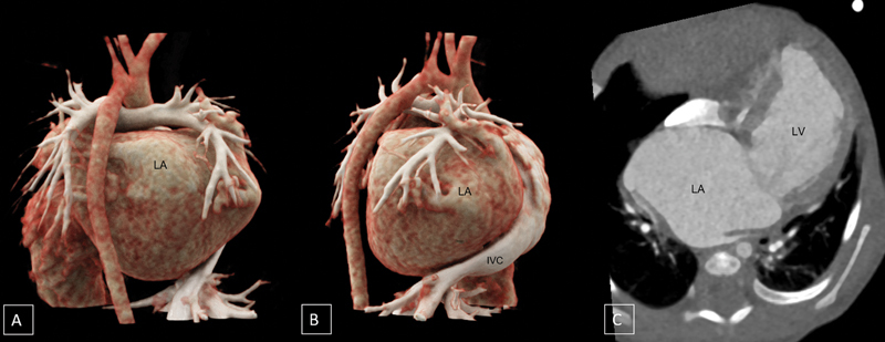 Giant Left Atrium in an Infant with Anomalous Origin of Left Coronary Artery from Pulmonary Artery.