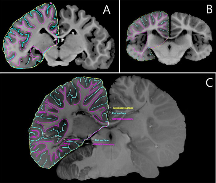 Stitcher: A Surface Reconstruction Tool for Highly Gyrified Brains.