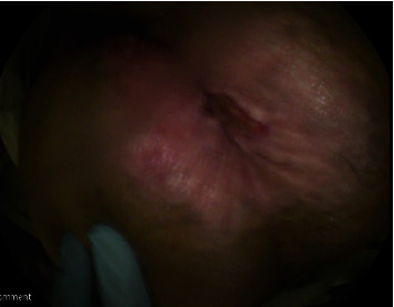 Rectal Adenocarcinoma With Pagetoid Spread: A Novel Entity.