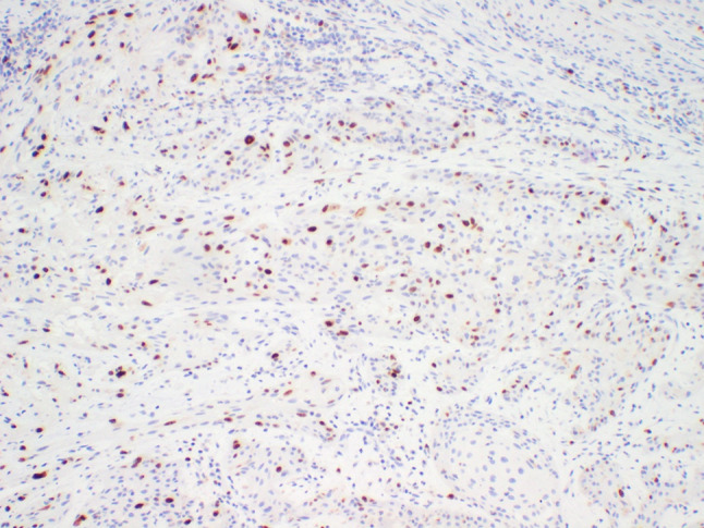 Squamous Cell Carcinoma Arising in a Squamous Odontogenic Tumor of the Maxilla: Case Report and Review of the Literature.