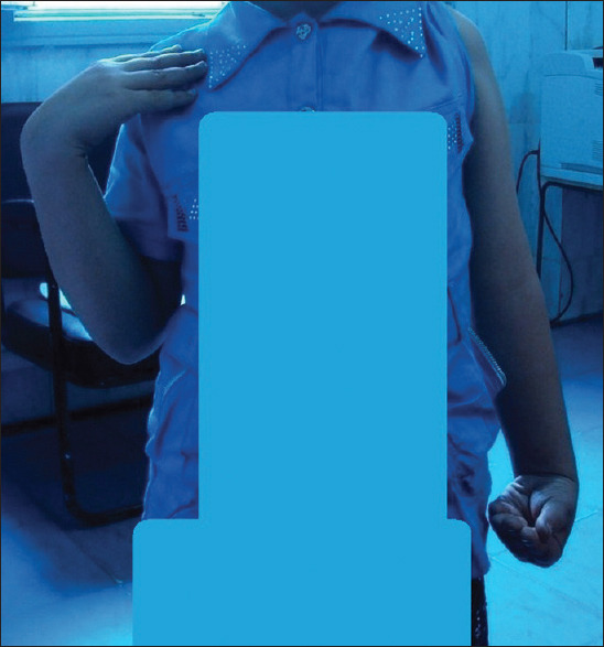 Staged Shoulder and Elbow Reconstruction in a Child with Obstetric Brachial Plexus Palsy: Six-year Follow-up.