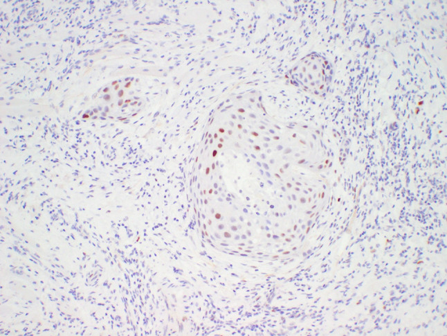 Squamous Cell Carcinoma Arising in a Squamous Odontogenic Tumor of the Maxilla: Case Report and Review of the Literature.