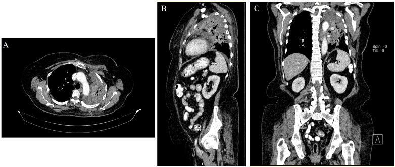 Primary Pulmonary Leiomyosarcoma Managed With Pazopanib: A Case Report and Literature Review.