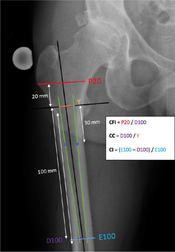 Influence of proximal femoral morphology on osteointegration of the AMIS uncemented femoral stem in modern hip arthroplasty.