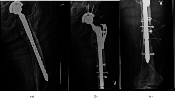 Implant Survival of an Uncemented Modular Femoral Implant in Patients With Severe Femoral Bone Loss and 2-Stage Hip Revision.