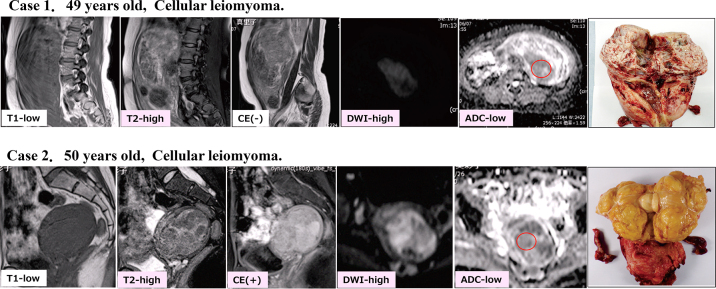 The utility of MRI for the preoperative differential diagnosis of uterine sarcoma and leiomyoma: a single-center study.
