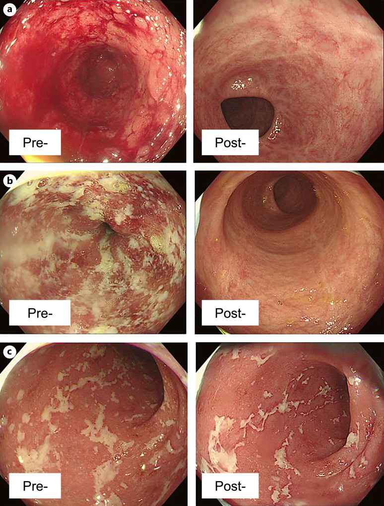 Real-World Effectiveness and Safety of Carotegrast Methyl in Japanese Patients with Moderately Active Ulcerative Colitis.