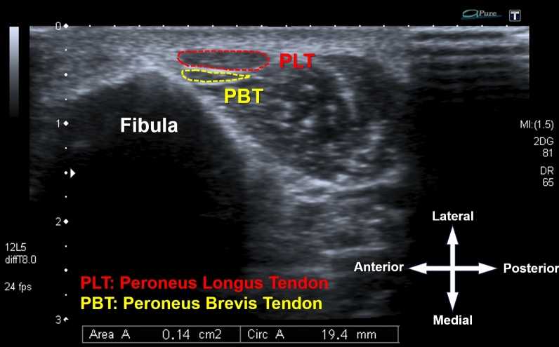 Relationship between peroneus longus tendon graft thickness and anthropometric variables: a radiographic study using ultrasonography.